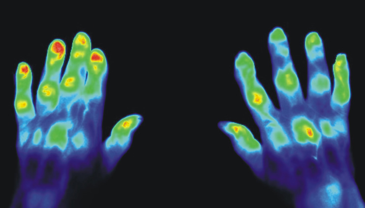 Eine medizinische Aufnahme von zwei Händen mit Hilfe von photolumineszenten Stoffen. 